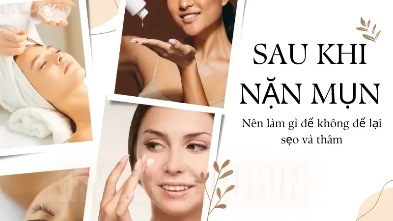 Sau khi lấy nhân mụn nên làm gì để không bị sẹo thâm? 1