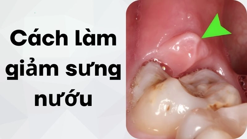 Tận dụng muối biển sát khuẩn nướu tức thì